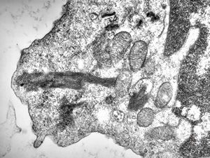 M,18y. | blood - tubular inclusions in lymphocytes M,18y. | blood - tubular inclusions in lymphocytes